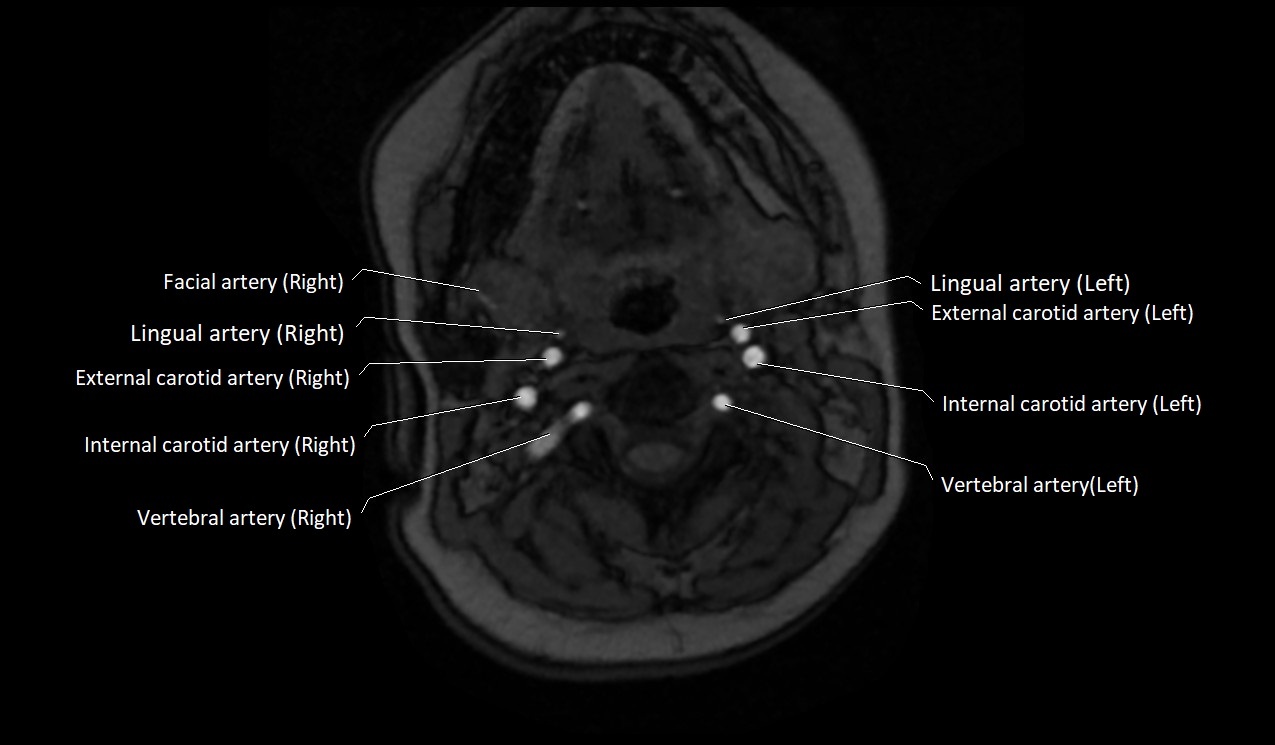 Carotid artery anatomy axial 3T image 22.jpg